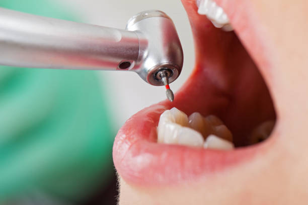 Best Emergency Root Canal Treatment in Sweet Home, OR